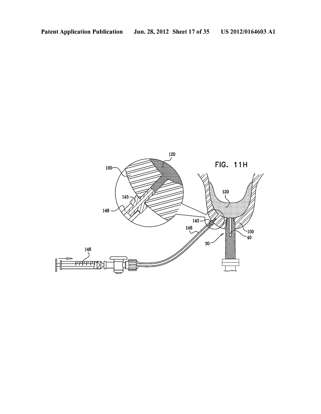 DENTAL IMPLEMENT HAVING LUMEN AND DISTAL THREADING - diagram, schematic, and image 18