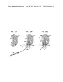 DENTAL IMPLEMENT HAVING LUMEN AND DISTAL THREADING diagram and image