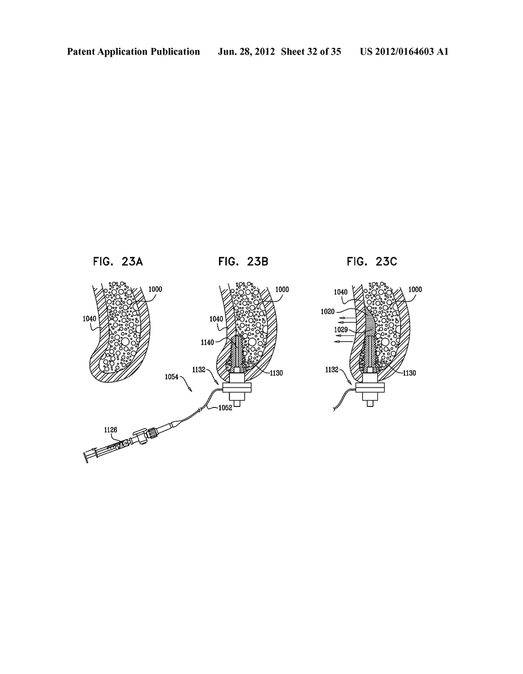 DENTAL IMPLEMENT HAVING LUMEN AND DISTAL THREADING - diagram, schematic, and image 33