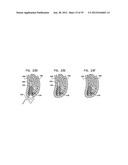 DENTAL IMPLEMENT HAVING LUMEN AND DISTAL THREADING diagram and image