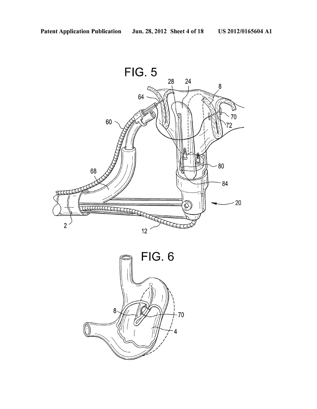 ENDOLUMINAL FOLD CREATION - diagram, schematic, and image 05