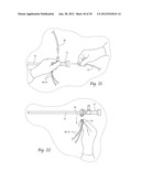 SYSTEMS AND METHODS FOR OPTIMIZING AND MAINTAINING VISUALIZATION OF A     SURGICAL FIELD DURING THE USE OF SURGICAL SCOPES diagram and image