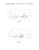 SYSTEMS AND METHODS FOR OPTIMIZING AND MAINTAINING VISUALIZATION OF A     SURGICAL FIELD DURING THE USE OF SURGICAL SCOPES diagram and image