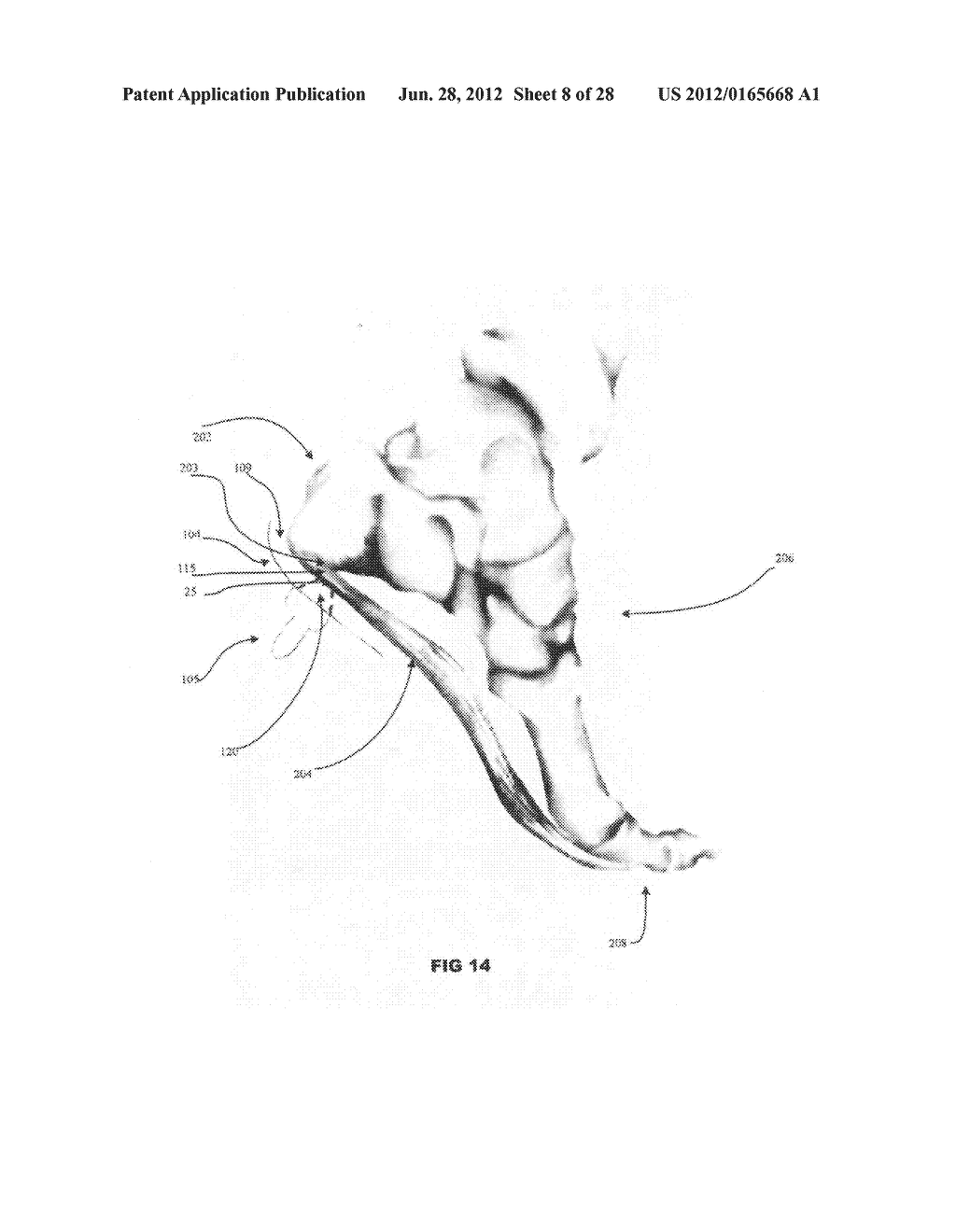 Systems and methods for treating acute and/or chronic injuries in soft     tissue - diagram, schematic, and image 09