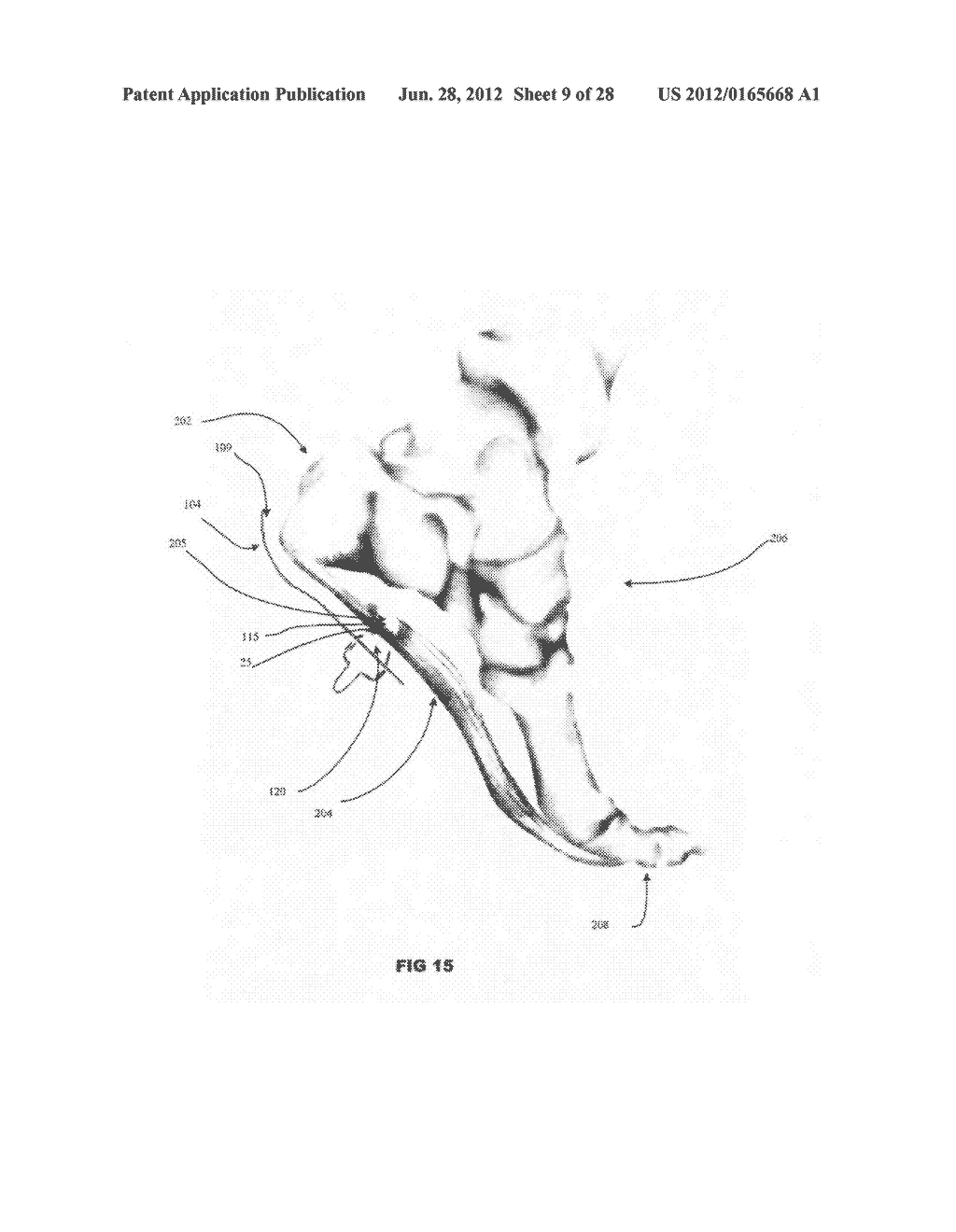 Systems and methods for treating acute and/or chronic injuries in soft     tissue - diagram, schematic, and image 10