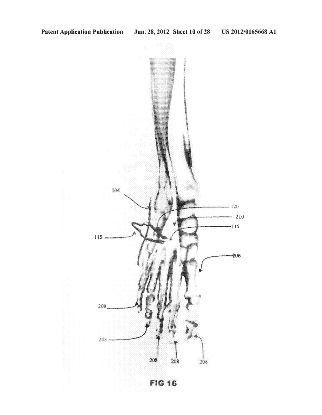 Systems and methods for treating acute and/or chronic injuries in soft     tissue - diagram, schematic, and image 11