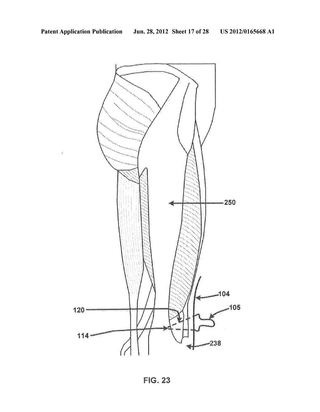 Systems and methods for treating acute and/or chronic injuries in soft     tissue - diagram, schematic, and image 18