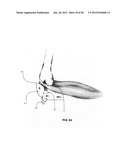 Systems and methods for treating acute and/or chronic injuries in soft     tissue diagram and image