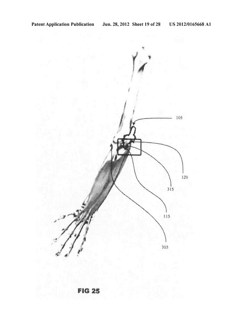 Systems and methods for treating acute and/or chronic injuries in soft     tissue - diagram, schematic, and image 20