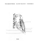 Systems and methods for treating acute and/or chronic injuries in soft     tissue diagram and image