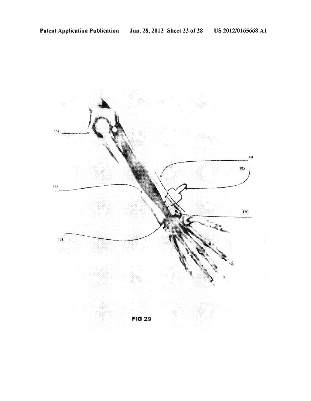 Systems and methods for treating acute and/or chronic injuries in soft     tissue - diagram, schematic, and image 24