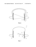 CONTRALATERAL ARRAY BASED CORRECTION OF TRANSCRANIAL ULTRASOUND ABERRATION diagram and image