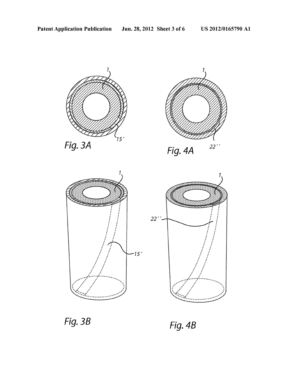 CATHETER ASSEMBLY AND A METHOD AND SYSTEM FOR PRODUCING SUCH AN ASSEMBLY - diagram, schematic, and image 04