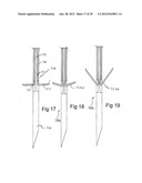 RADIO FREQUENCY ABLATION DEVICE FOR THE DESTRUCTION OF TISSUE MASSES diagram and image