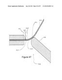 RADIO FREQUENCY ABLATION DEVICE FOR THE DESTRUCTION OF TISSUE MASSES diagram and image