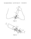 Endoscopic Suturing Device, System and Method diagram and image