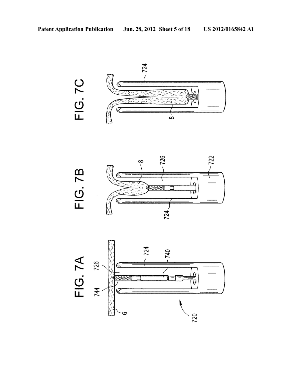 ENDOLUMINAL FOLD CREATION - diagram, schematic, and image 06