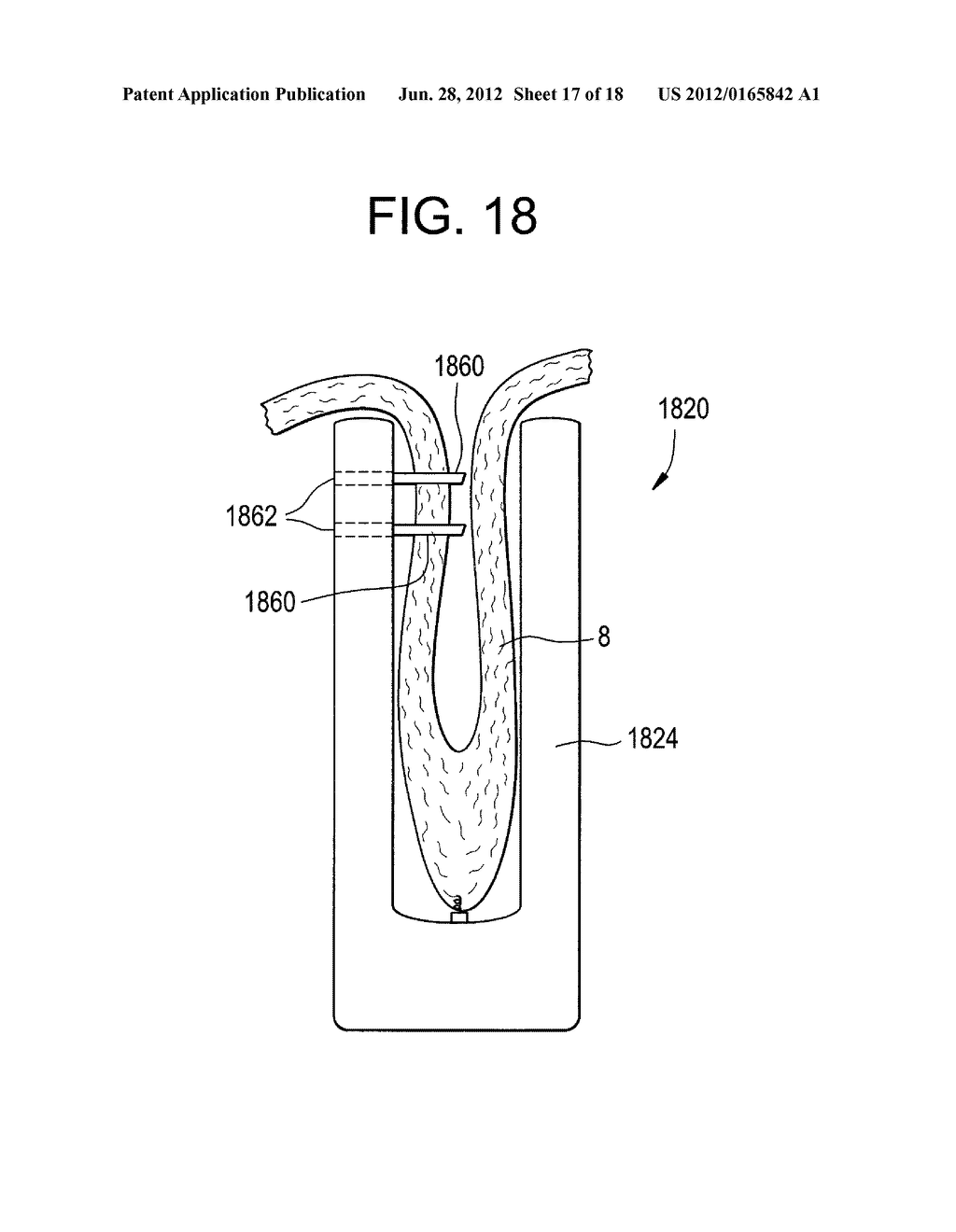 ENDOLUMINAL FOLD CREATION - diagram, schematic, and image 18