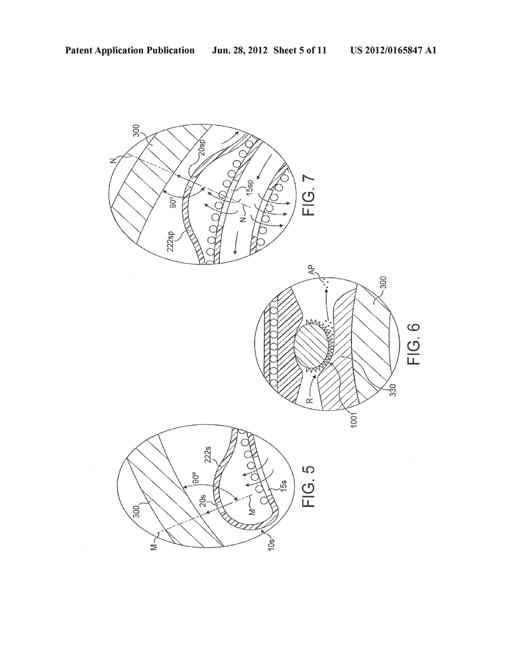 Rotational Atherectomy Device with Fluid Inflatable Support Elements     Supported by Fluid Bearings - diagram, schematic, and image 06