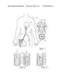 Femoral Vein Catheter for Improving Cardiac Output, Drug Delivery and     Automated CPR Optimization diagram and image