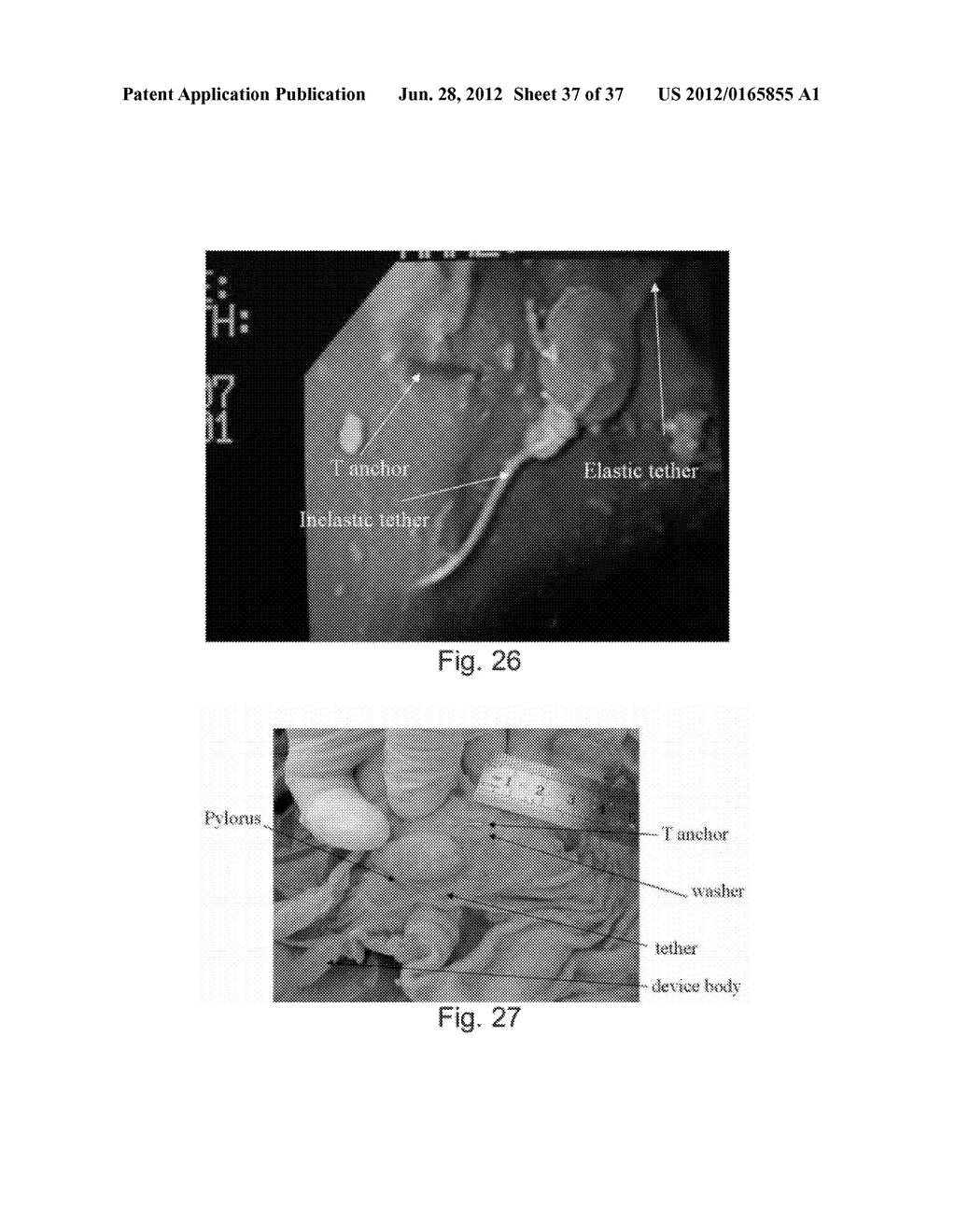 DEVICES AND METHODS FOR ALTERING EATING BEHAVIOR - diagram, schematic, and image 38