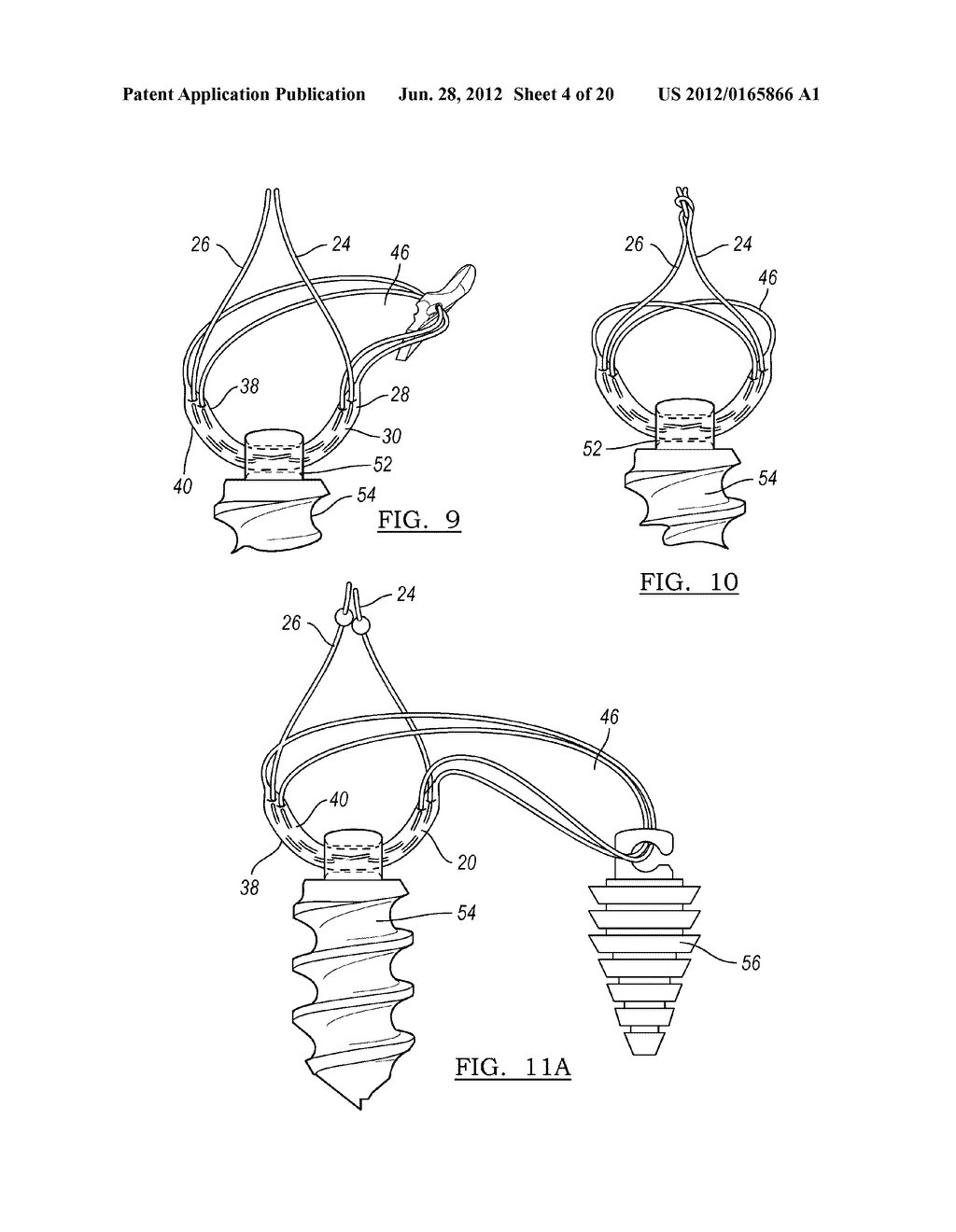 Method and Apparatus for Coupling Soft Tissue to Bone - diagram, schematic, and image 05
