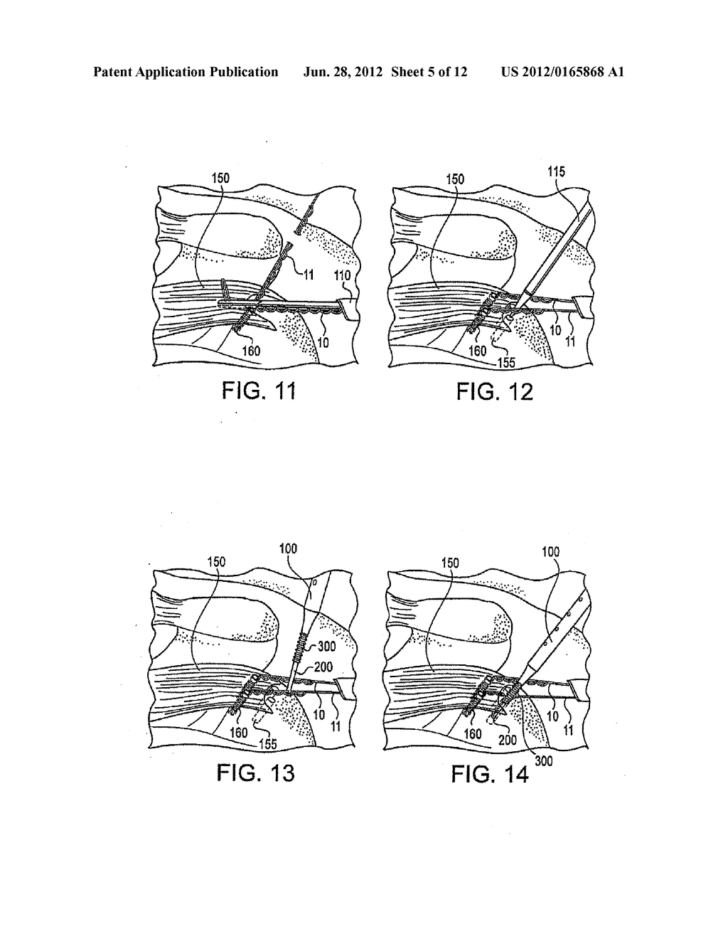 FENESTRATED SUTURE ANCHOR AND METHOD FOR KNOTLESS FIXATION OF TISSUE - diagram, schematic, and image 06