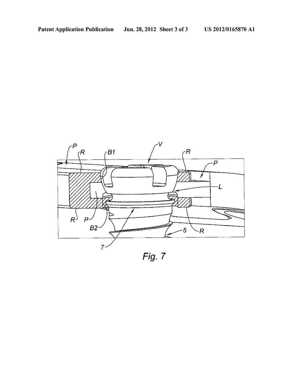 PLATE-AND-SCREW IMPLANT ASSEMBLY FOR BONE FIXATION - diagram, schematic, and image 04