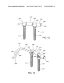 Method For Stabilizing A Spine diagram and image