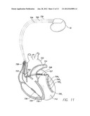 Systems and Methods for Determining Optimal Interventricular Pacing Delays     Based on Electromechanical Delays diagram and image