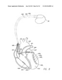 SYSTEMS AND METHODS FOR OPTIMIZING AV/VV PACING DELAYS USING COMBINED     IEGM/IMPEDANCE-BASED TECHNIQUES FOR USE WITH IMPLANTABLE MEDICAL DEVICES diagram and image