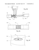 EMERGENCY VASCULAR REPAIR PROSTHESIS DEPLOYMENT SYSTEM diagram and image