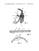 Method and Device for Treatment of Mitral Insufficiency diagram and image