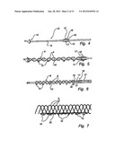 Method and Device for Treatment of Mitral Insufficiency diagram and image