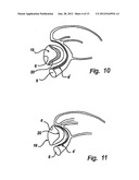 Method and Device for Treatment of Mitral Insufficiency diagram and image