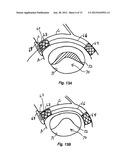 Method and Device for Treatment of Mitral Insufficiency diagram and image