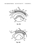 Method and Device for Treatment of Mitral Insufficiency diagram and image