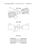 Method and Device for Treatment of Mitral Insufficiency diagram and image