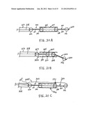 Method and Device for Treatment of Mitral Insufficiency diagram and image