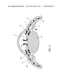 UVEOSCLERAL DRUG DELIVERY IMPLANT AND METHODS FOR IMPLANTING THE SAME diagram and image