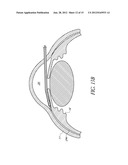 UVEOSCLERAL DRUG DELIVERY IMPLANT AND METHODS FOR IMPLANTING THE SAME diagram and image