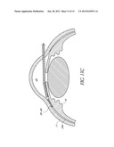 UVEOSCLERAL DRUG DELIVERY IMPLANT AND METHODS FOR IMPLANTING THE SAME diagram and image