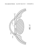 UVEOSCLERAL DRUG DELIVERY IMPLANT AND METHODS FOR IMPLANTING THE SAME diagram and image