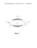 CEMENT-DIRECTING ORTHOPEDIC IMPLANTS diagram and image