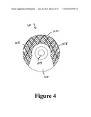 CEMENT-DIRECTING ORTHOPEDIC IMPLANTS diagram and image