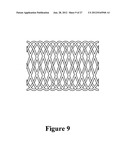 CEMENT-DIRECTING ORTHOPEDIC IMPLANTS diagram and image