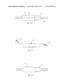 Universal laminoplasty implant diagram and image