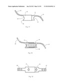 Universal laminoplasty implant diagram and image