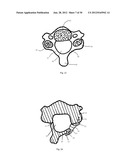 Universal laminoplasty implant diagram and image