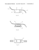 Universal laminoplasty implant diagram and image